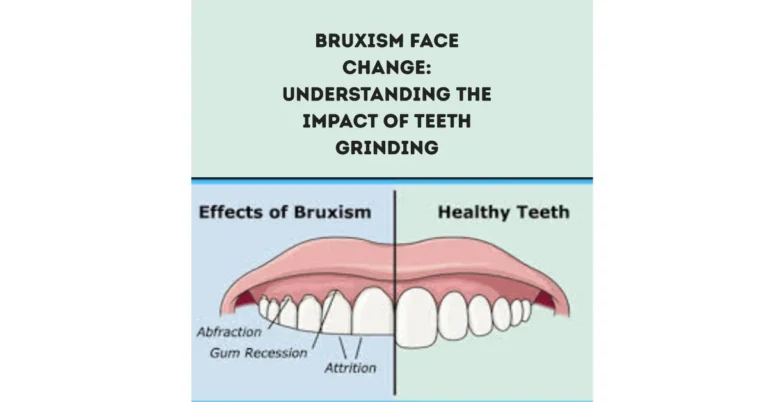 Bruxism Face Change Understanding the Impact of Teeth Grinding