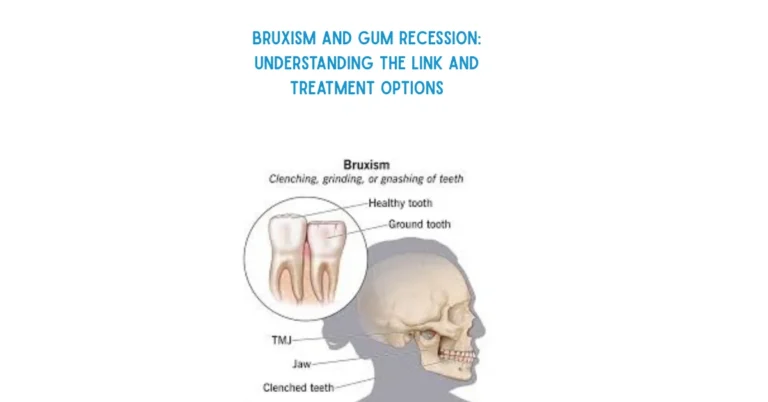 Bruxism and Gum Recession Understanding the Link and Treatment Options