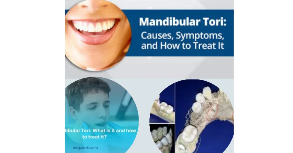 Mandibular Tori Stages, Causes, and Treatment