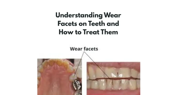 Understanding Wear Facets on Teeth and How to Treat Them