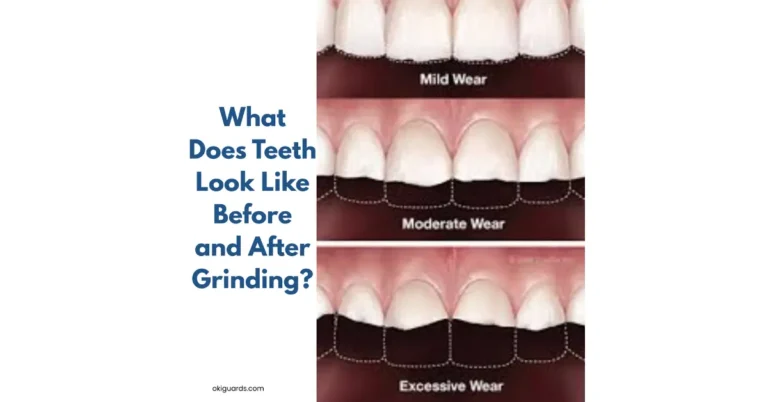 What Does Teeth Look Like Before and After Grinding