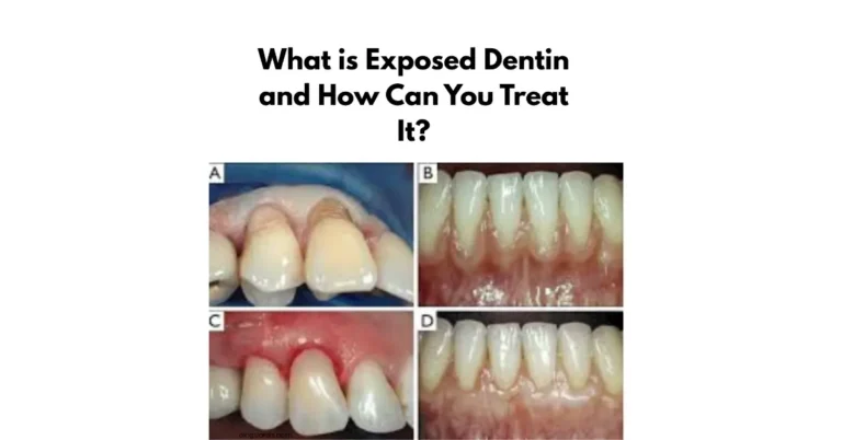 What is Exposed Dentin and How Can You Treat It? 4 What is Exposed Dentin and How Can You Treat It