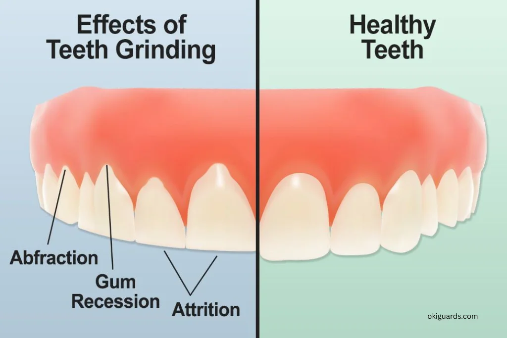 Tooth Sensitivity from Grinding